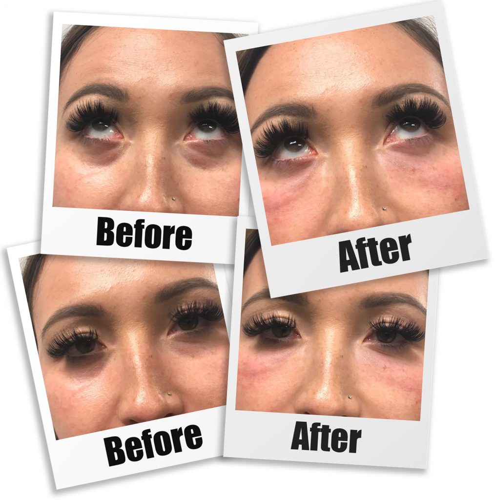 tear-trough-treatment-using-dermal-fillers-dr-medispa-essex-london